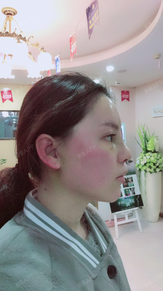 鼻骨矫正 | 鼻部修复 | 自体脂肪隆鼻 | 南京同城 | 徐州同城