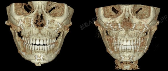 双鄂手术是移动量不大的时候,反而更有难度.
