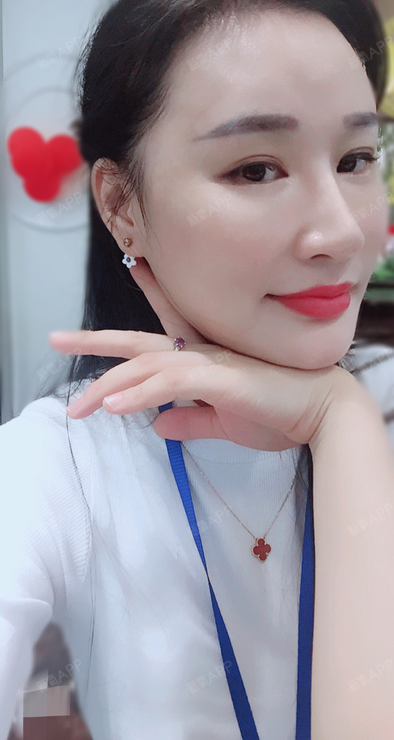 下颌角整形好不好_效果图_网红氧仙女下颌角整形术