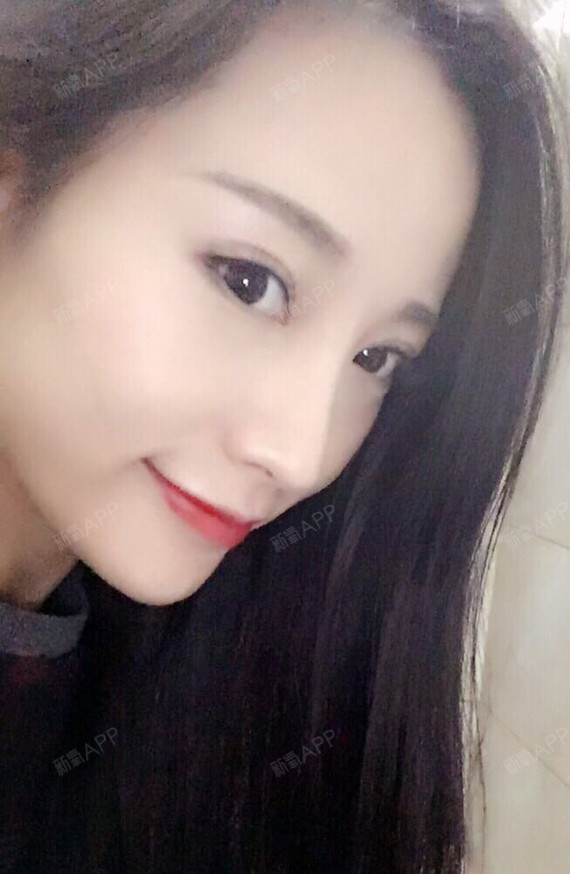 这广尾型的的大双眼皮是不是很符合我明媚动人的气质的_圈子-新氧美容