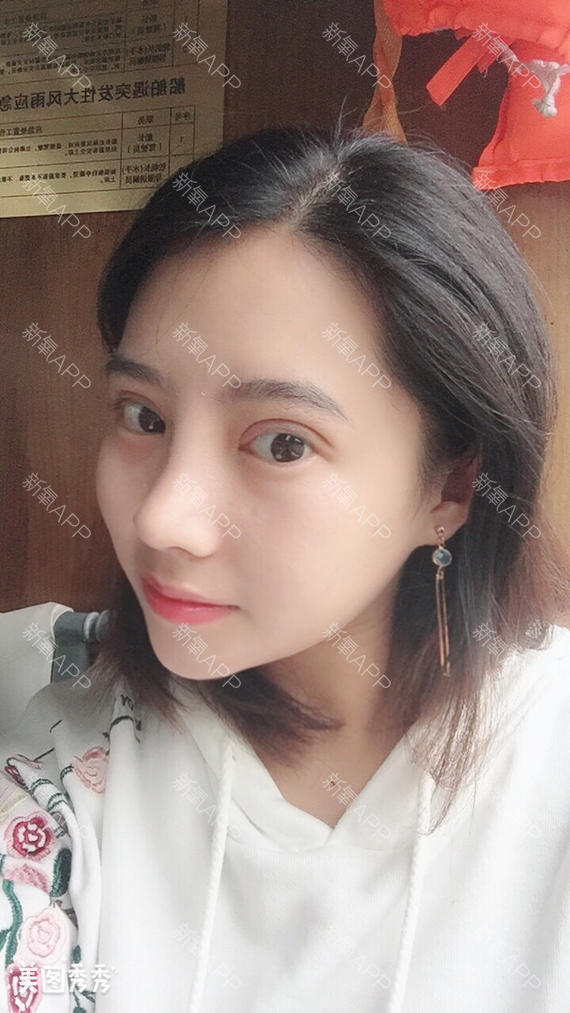 鼻综合怎么样_恢复过程_效果如何_爱飞的鱼整形日记9.8_新氧美容整形