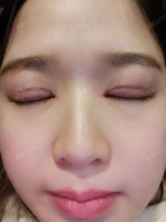 新氧- 张志明小老婆 | 眼部 | 双眼皮 | 切开双眼皮 | 术后当自强