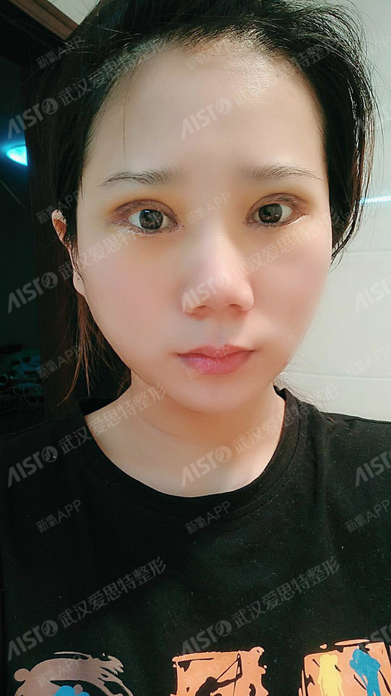 武汉眼部多项好不好_效果图_你是我的小心肝呀呀呀眼部多项术后第10天