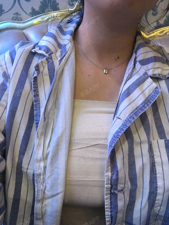 成都假体隆胸好不好_效果图_璐璐拒绝平胸假体隆胸术后第3天_新氧美容