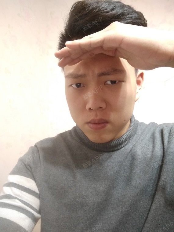 【恒博植发种植眉毛术后43天】虽然眉毛现在还处于脱落期,还有