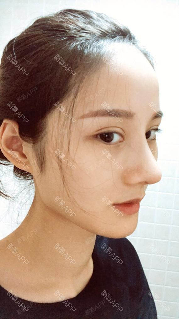 济南海峡美容整形医院隆鼻第86天有评论说我像热巴,_圈子-新氧美容整