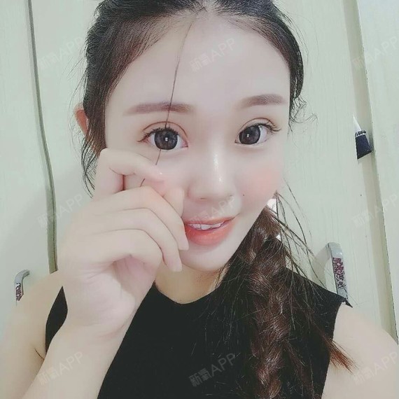 术后一个多月,蓉雅做的双眼皮真的恢复的超级好,现在看起来眼睛又