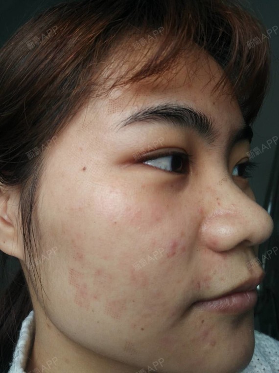 点阵激光第三天啦,氧气们~过来更新一下术后三天的样_圈子-新氧美容