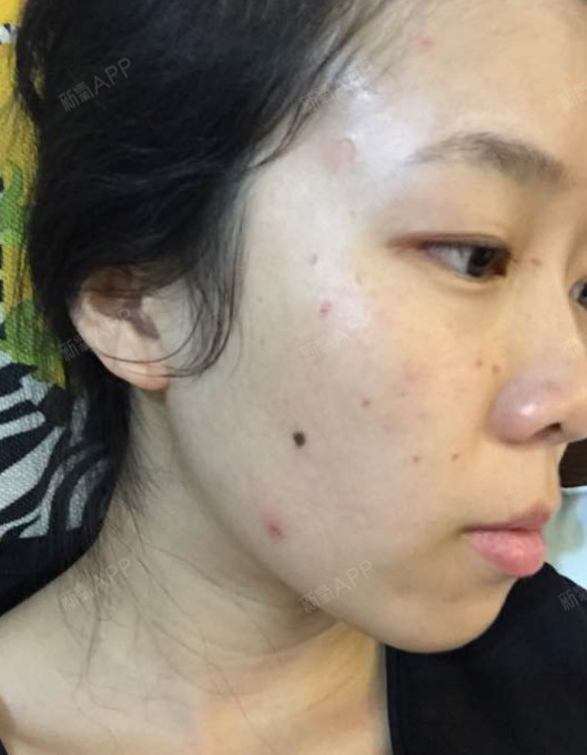 点完第一天.怎么还不结痂