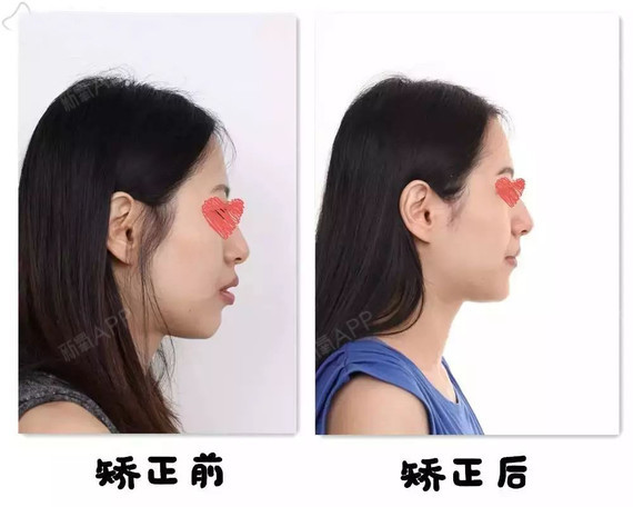 颏部,也就是人们口中的下巴,是我们面下1/3的重要_圈子-新氧美容整形