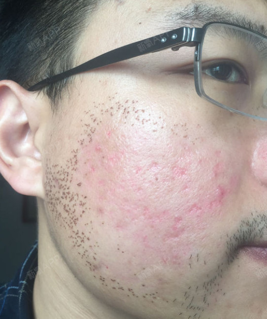 皮肤 | 术后当自强 | 深圳同城 | 激光祛痘祛痘印