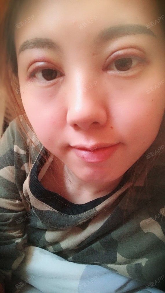 【沈阳丽都切开双眼皮 开内眼角案例分享】