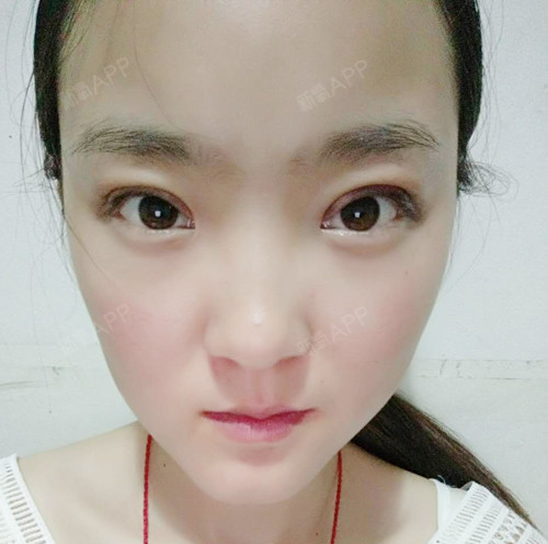 萌小呆萌萌萌定点双眼皮第2天美丽日记