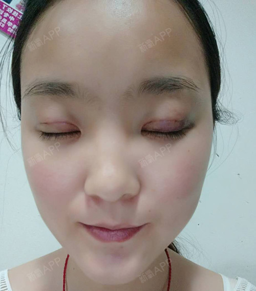 萌小呆萌萌萌定点双眼皮术后第2天美丽日记_新氧整形