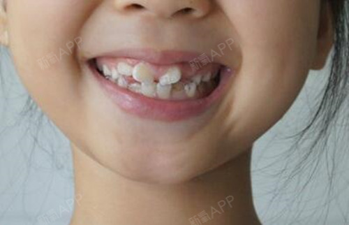 广州圣贝口腔——不做"坑娃"的家长:儿童牙齿不齐的_圈子-新氧美容