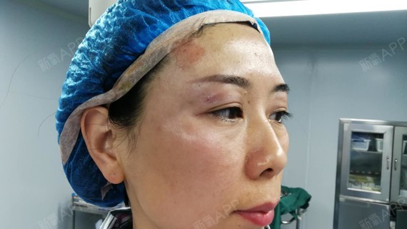 自体脂肪填充丰眼窝当天眼睛有点轻微的肿胀感眼部肌肤变得饱满紧致