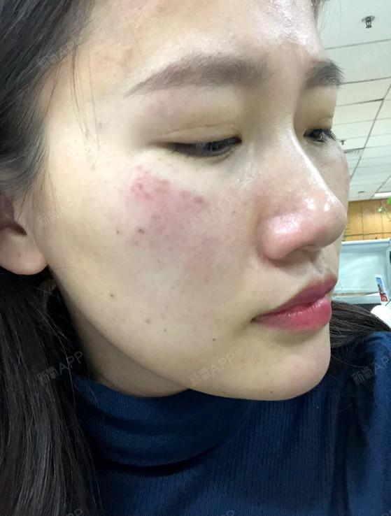 超皮秒祛斑术后第3天