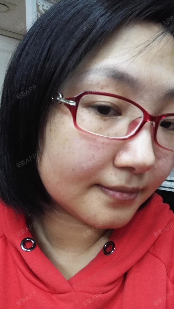 激光祛斑术后20天