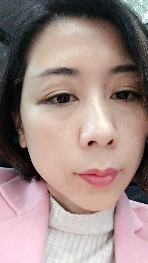 自体脂肪面部填充