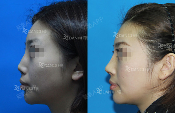 挛缩鼻修复,该患者由于外伤,假体取出后鼻头、