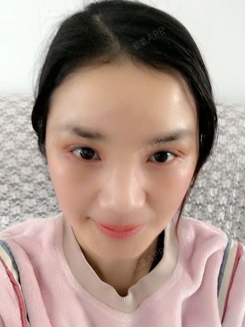 【苏州美莱双眼皮术后第7天】今天终于来医院拆线啦!