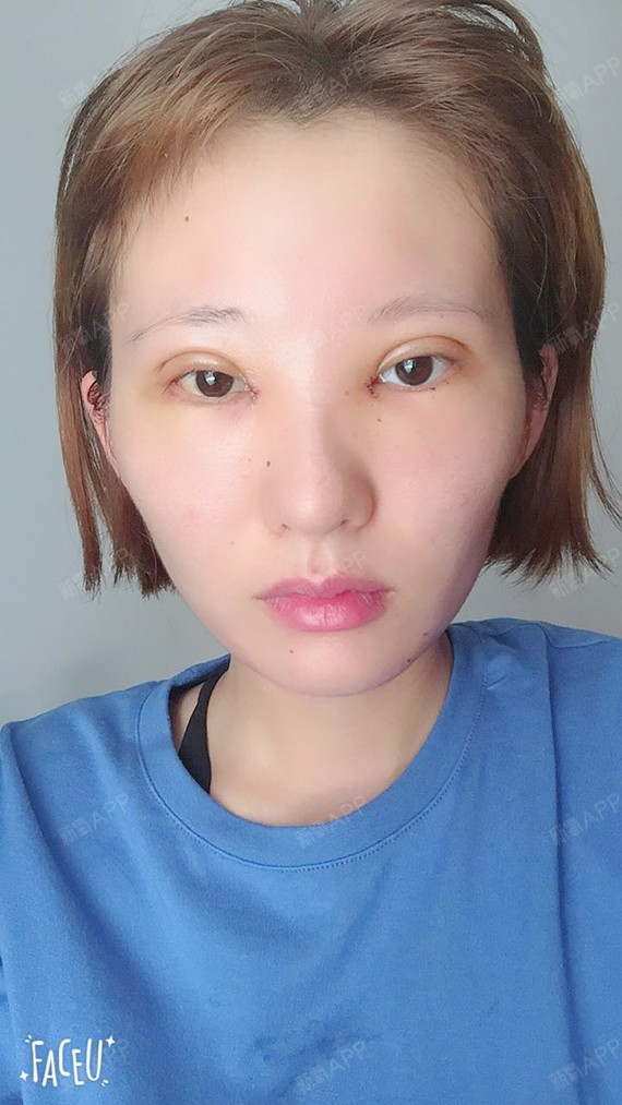 埋线双眼皮