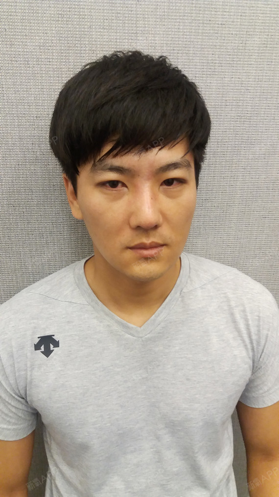 首尔特别埋线双眼皮好不好_效果图_加美整形外科医院埋线双眼皮术后第