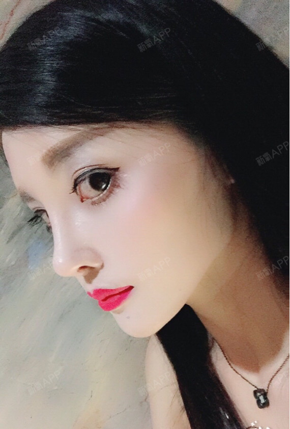 上海膨体隆鼻好不好_效果图_纪幻巧i膨体隆鼻术后第22天_新氧美容整形