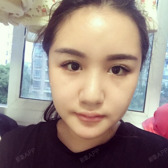 韩式生科硅胶隆下巴