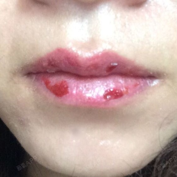 术后第5天     结痂脱落期    34 0         0    发布于:2018年2月25