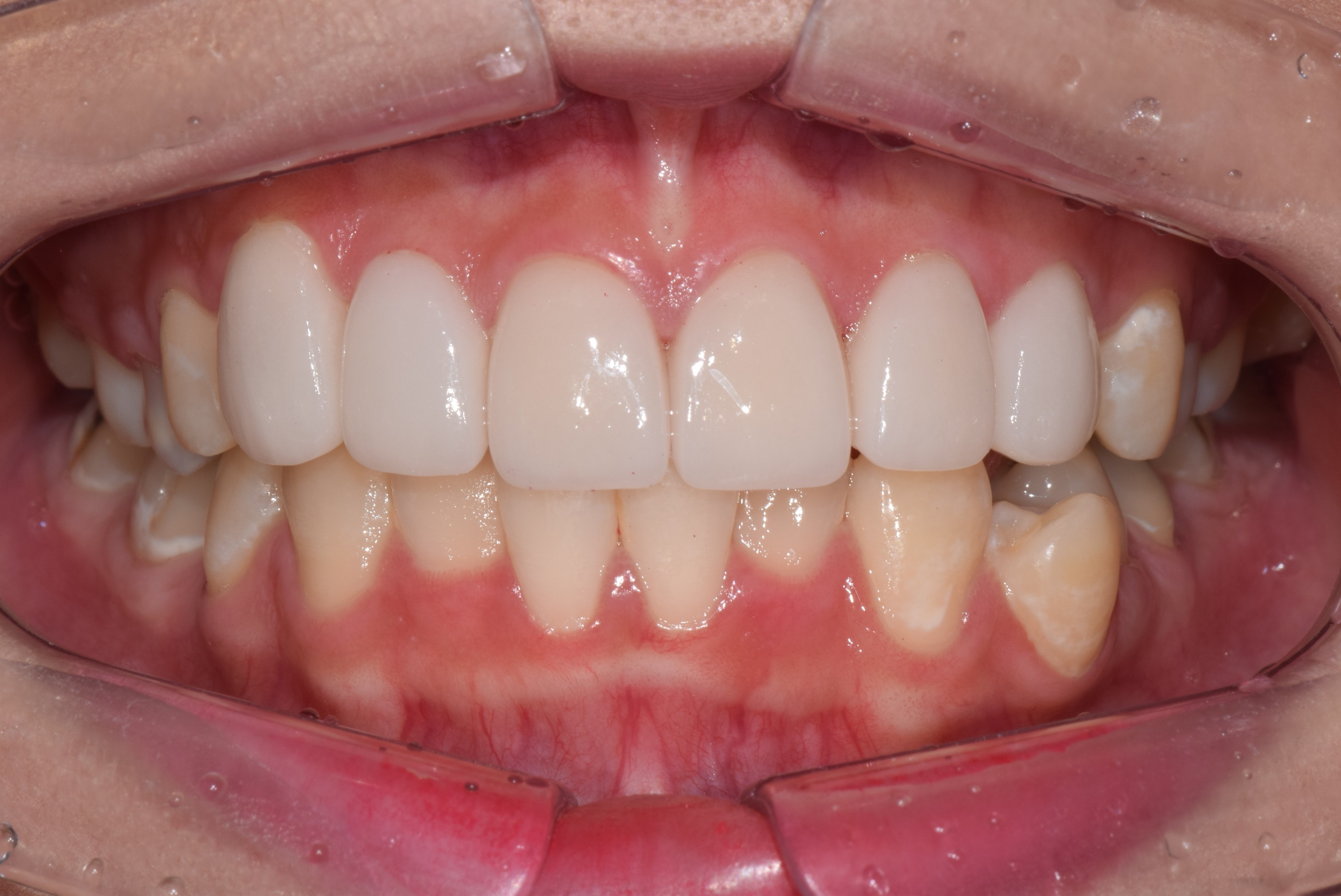 瓷贴面的价格_相关案例_新氧整形