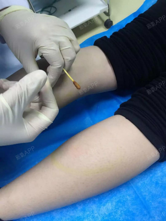 之后50单位是注射在内腓肠肌上,就是注射的这个位置.
