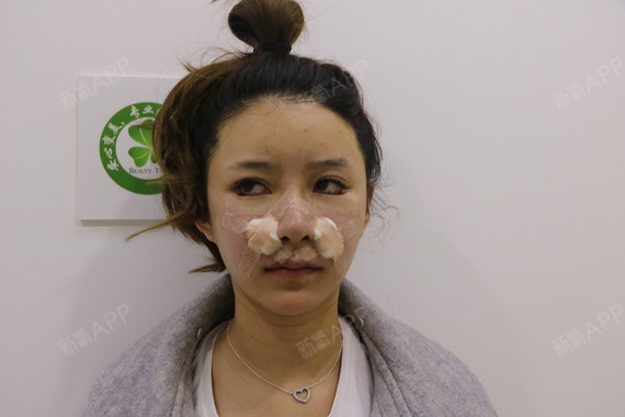 鼻基底好不好_效果图_跌跌撞撞1假体垫鼻基底术后第0天_新氧美容整形