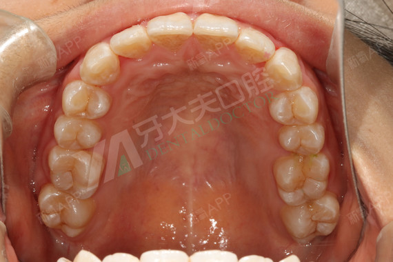 看到现在牙齿一点一点开始变整齐就觉得一切都是值得的