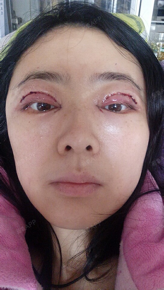 天生鱼泡眼和因为年龄大了上眼皮有些下垂,和隽医生建议做上眼睑去皮