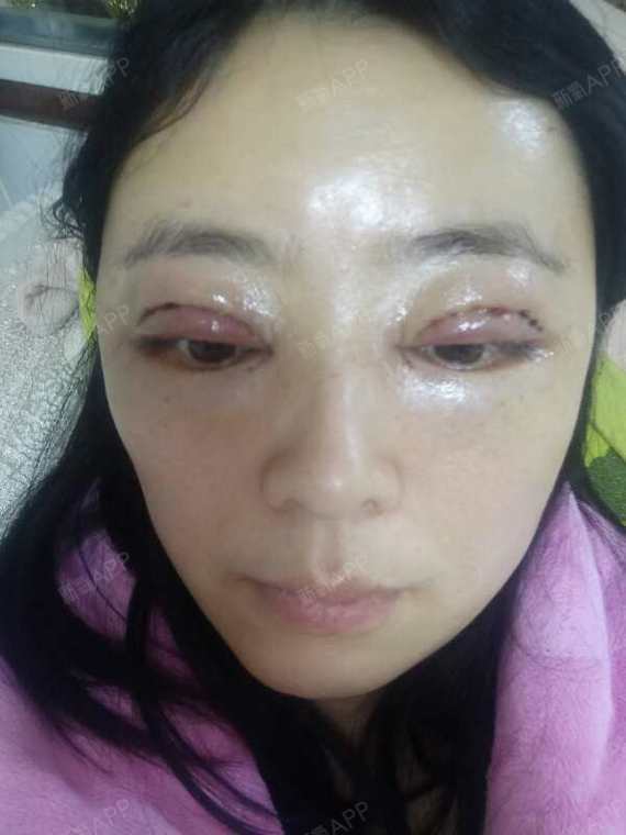 新氧 氧气4892351519368638 眼部 术后当自强 长沙同城 眼部