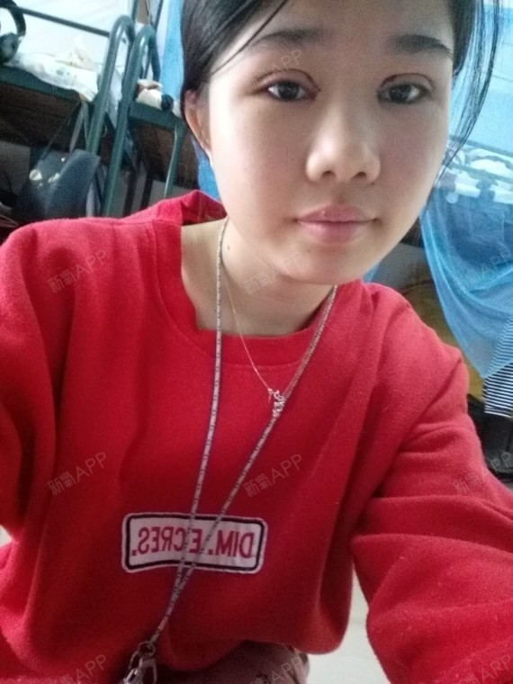 明天就要拆线了哈哈哈,今天没有昨天红了,感觉肿还是_圈子-新氧美容