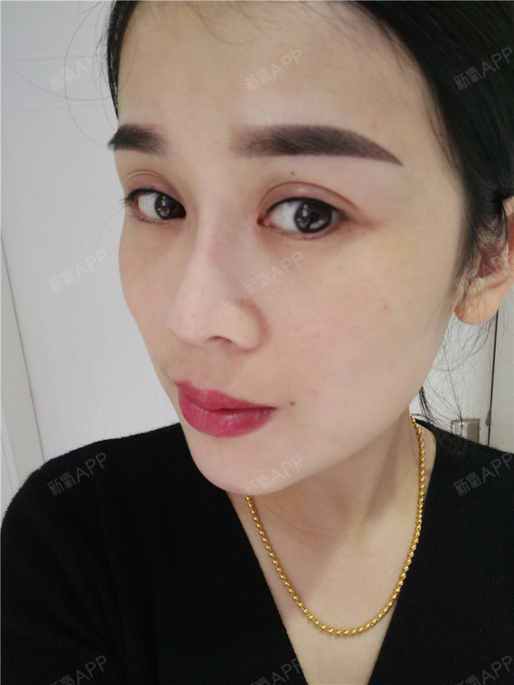 眼皮肿了,不过老师有说做完美瞳线会肿是正常的,过两_圈子-新氧美容
