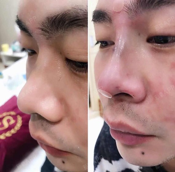 男人的线雕鼻也可以很精致