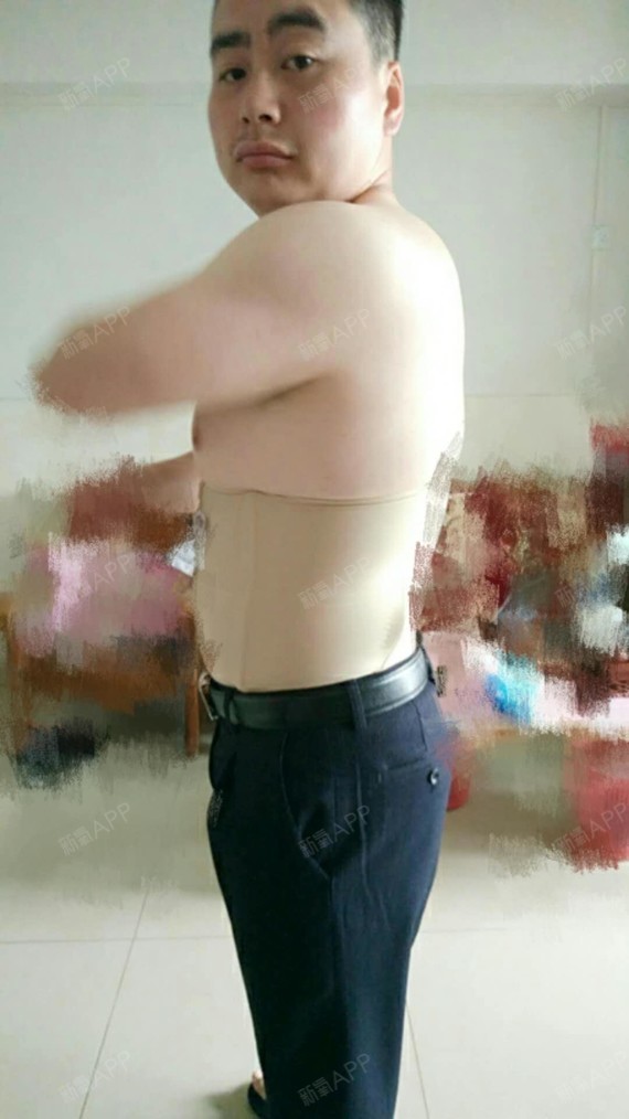 深圳吸脂瘦腹部好不好_效果图_峰震吸脂瘦腹部术后第20天_新氧美容