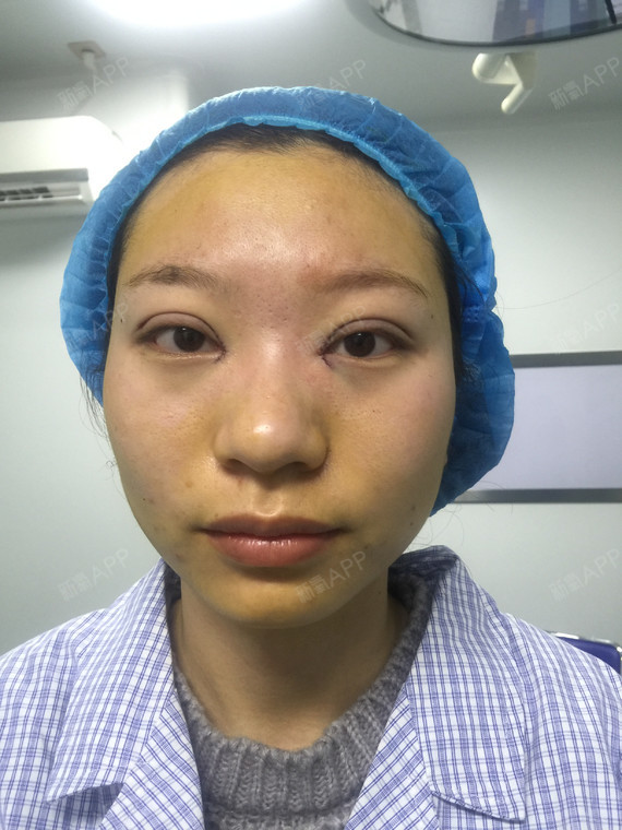 单眼皮这么多年了眼睛肿没精神术前第一张是手机拍的术前第二张是相机