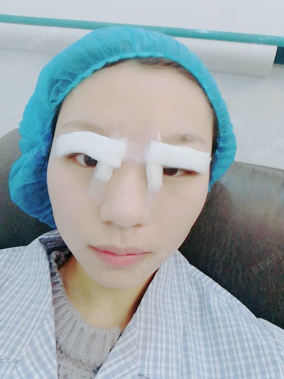 单眼皮这么多年了眼睛肿没精神术前第一张是手机拍的术前第二张是相机