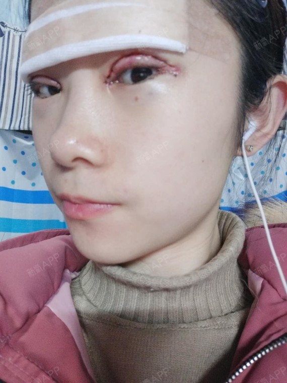 手术第一天.双眼皮做的挺满意的.