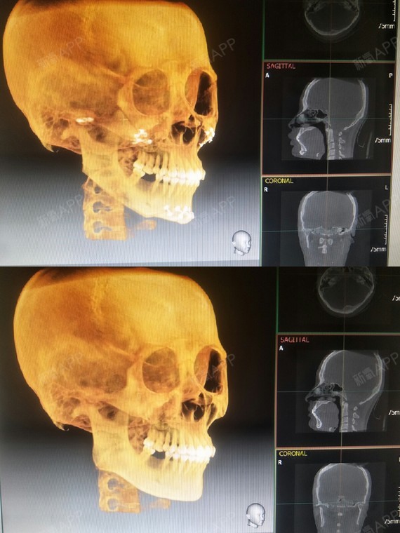 仔細看就能發現ct左右下巴截骨前移的有一點不