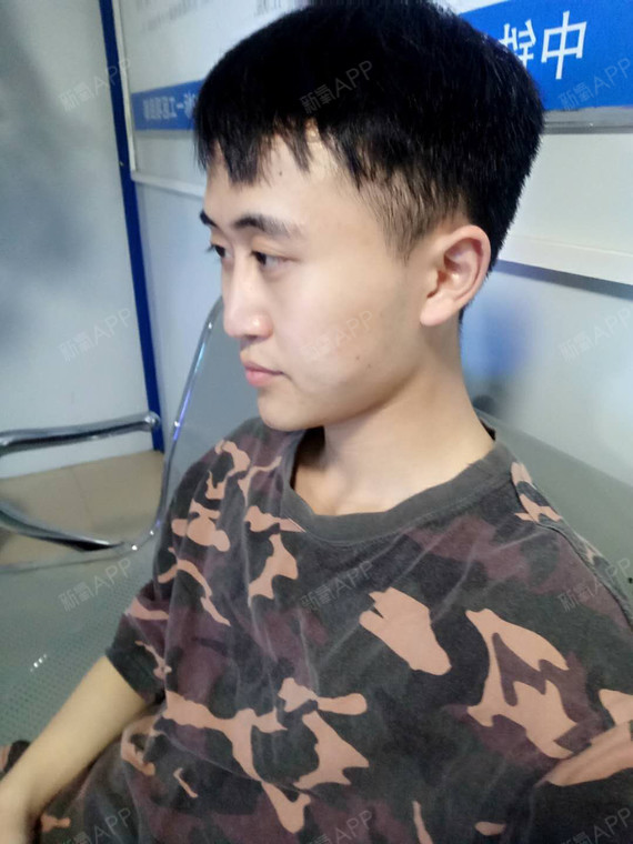 时间过得真快啊在晨曦医院做下巴已经一个多月了