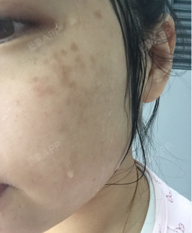 哈哈又来蛋白皮肤管理中心做皮秒了