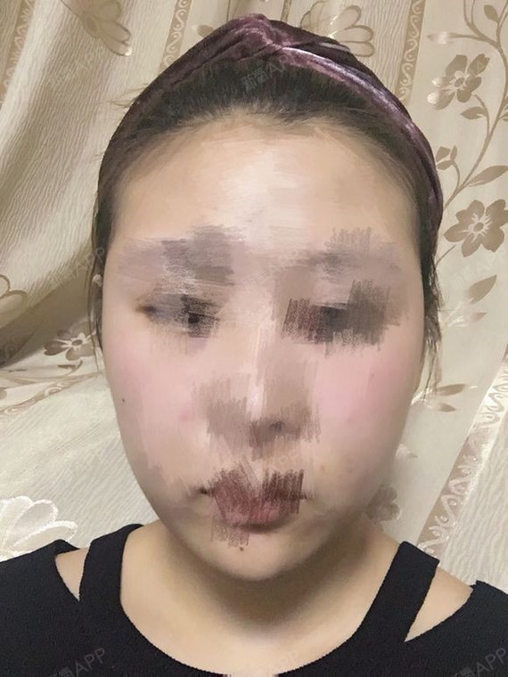 瘦脸针打完第八天了～我真没有任何咬不动东西的感觉,_圈子-新氧美容