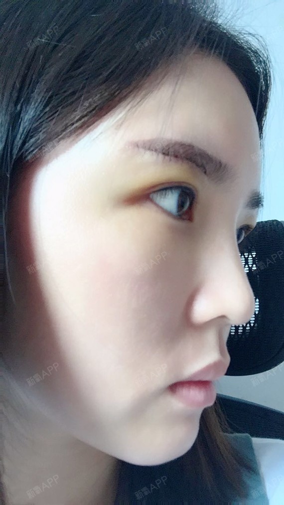 深圳切眉术好不好_效果图_氧气m6jf709切眉术术后第5天_新氧美容整形