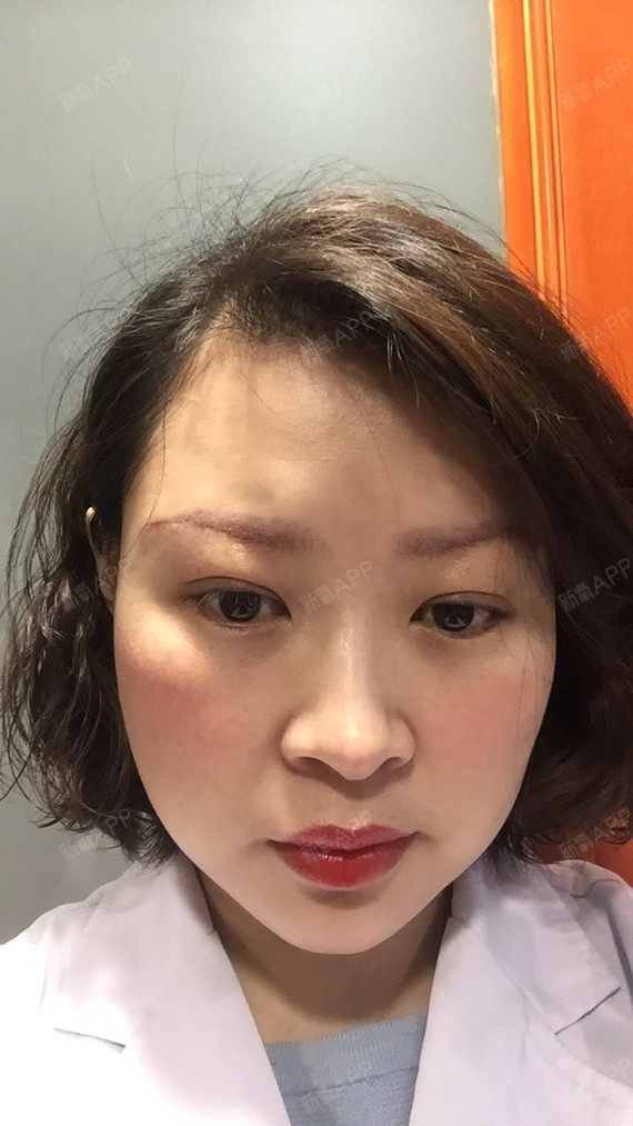 【切眉术后第12天】昨天刚给女儿过完女生节,今天就_圈子-新氧美容