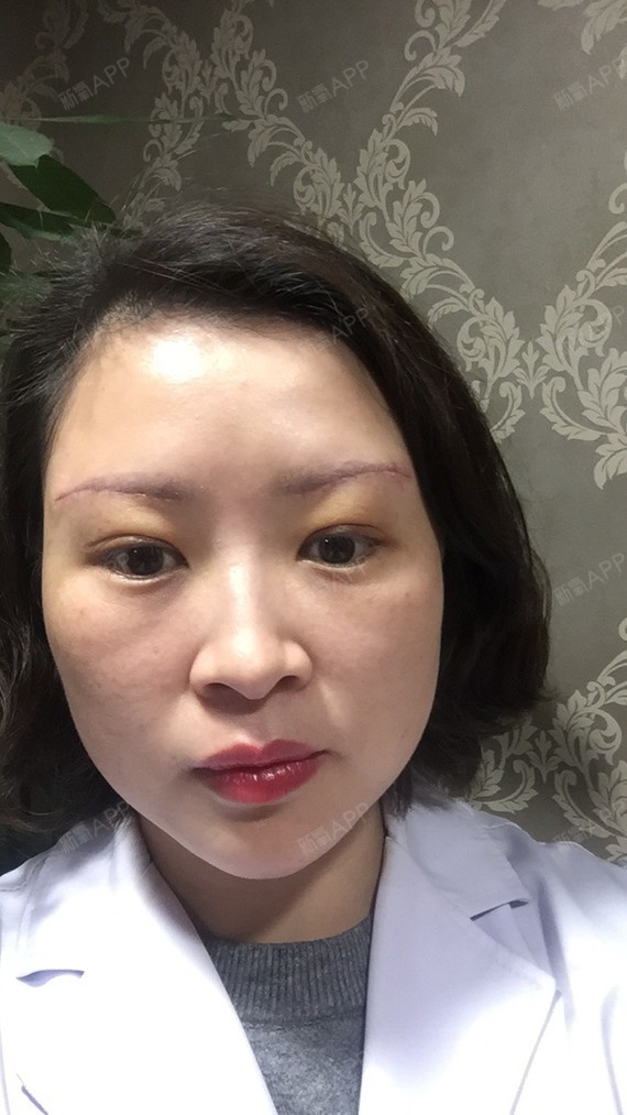 【切眉术后第7天】我来了,今天带了一个超显嫩的眼镜_圈子-新氧美容